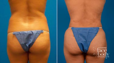 Hidden Liposuction  Before & After Gallery - Patient 591222 - Image 1