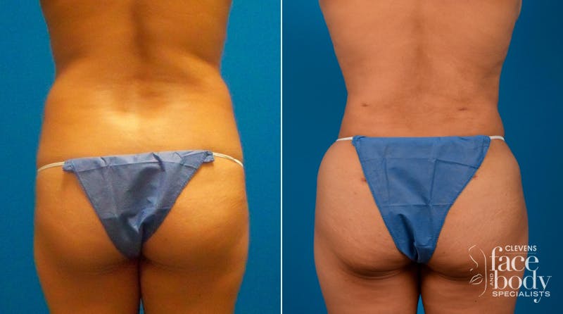 Hidden Liposuction Before & After Gallery - Patient 591222 - Image 1