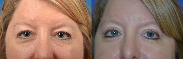 Eyelid Surgery Before & After Gallery - Patient 142357 - Image 1