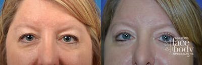 Eyelid Surgery Before & After Gallery - Patient 142357 - Image 1