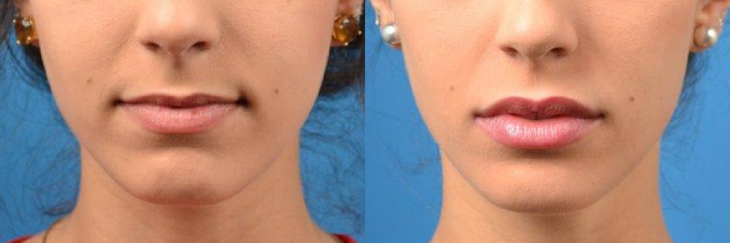 Lip Fillers Before & After Gallery - Patient 122406091 - Image 1