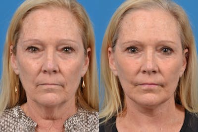 Facelift Before & After Gallery - Patient 122406100 - Image 1