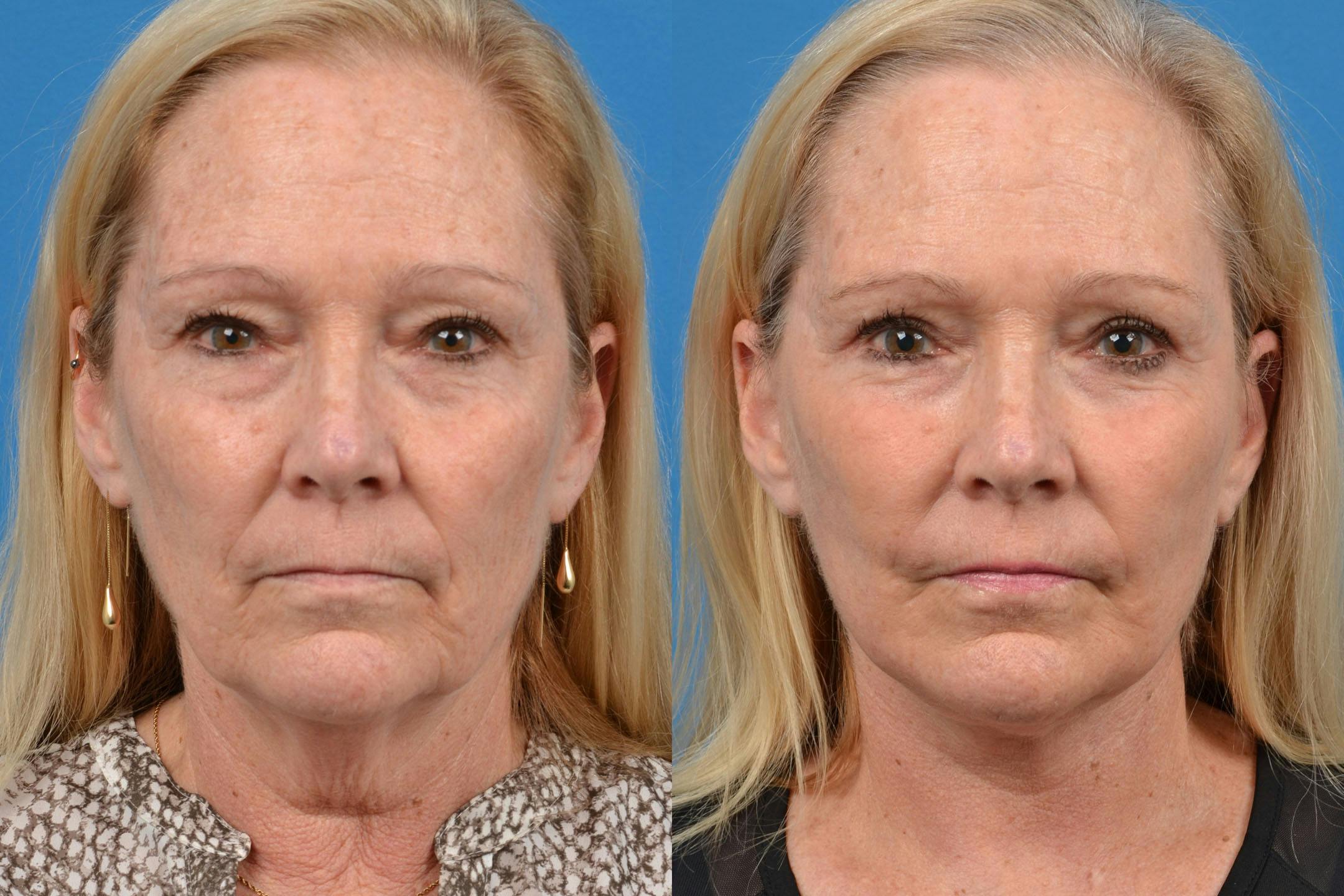 Facelift Before & After Gallery - Patient 122406100 - Image 1