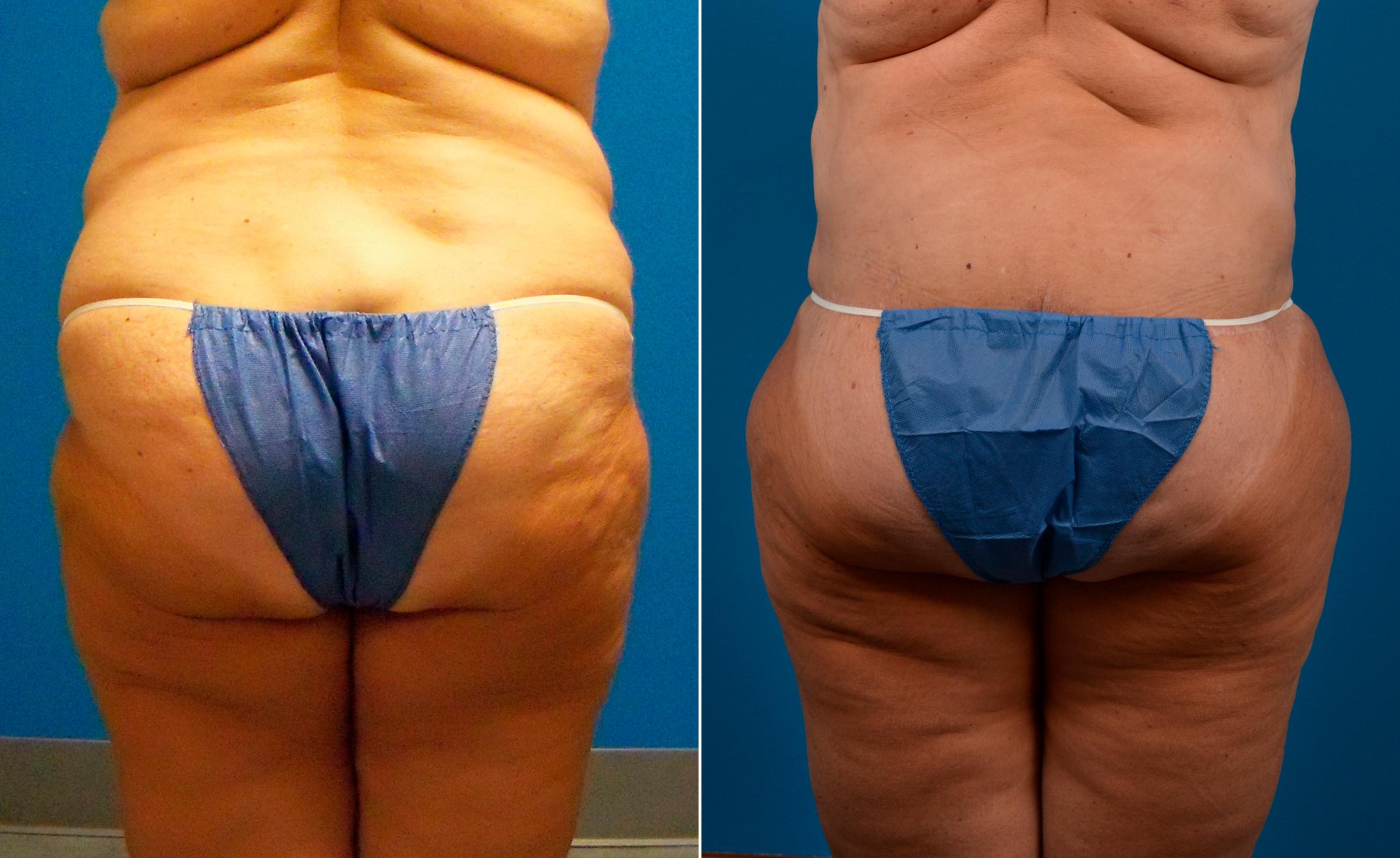 Hidden Liposuction  Before & After Gallery - Patient 127018 - Image 1