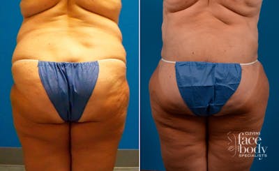 Hidden Liposuction  Before & After Gallery - Patient 127018 - Image 1