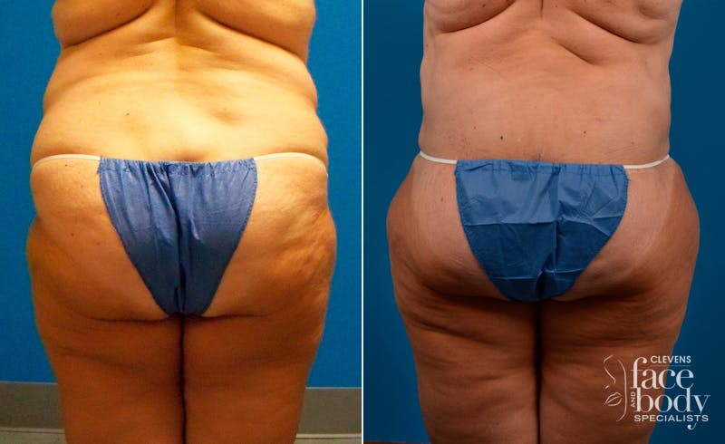 Hidden Liposuction  Before & After Gallery - Patient 127018 - Image 1