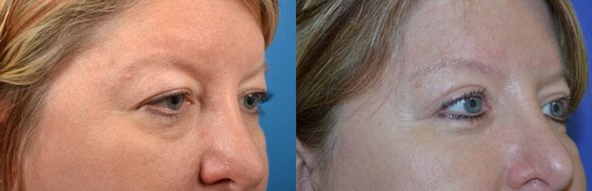 Eyelid Surgery Before & After Gallery - Patient 122406093 - Image 2
