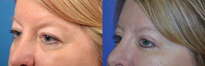 Eyelid Surgery Before & After Gallery - Patient 142357 - Image 3
