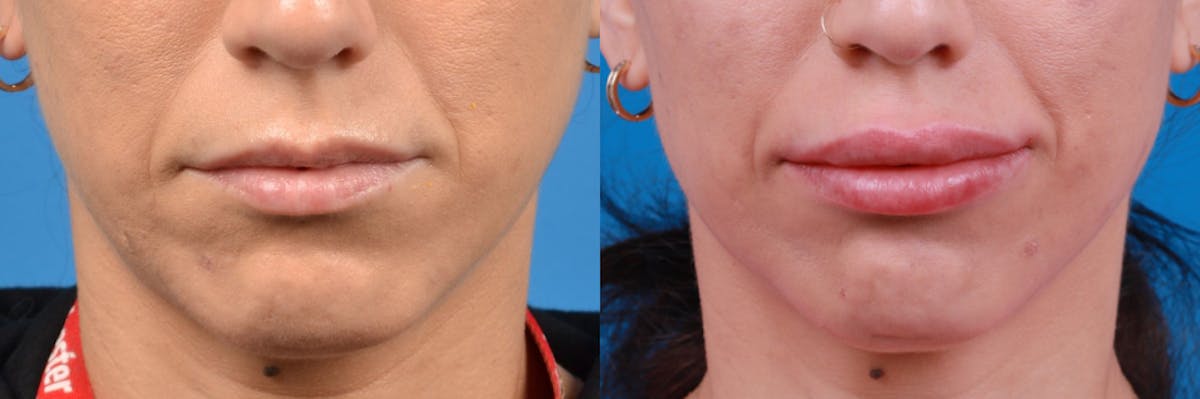 Lip Fillers Before & After Gallery - Patient 122406094 - Image 1
