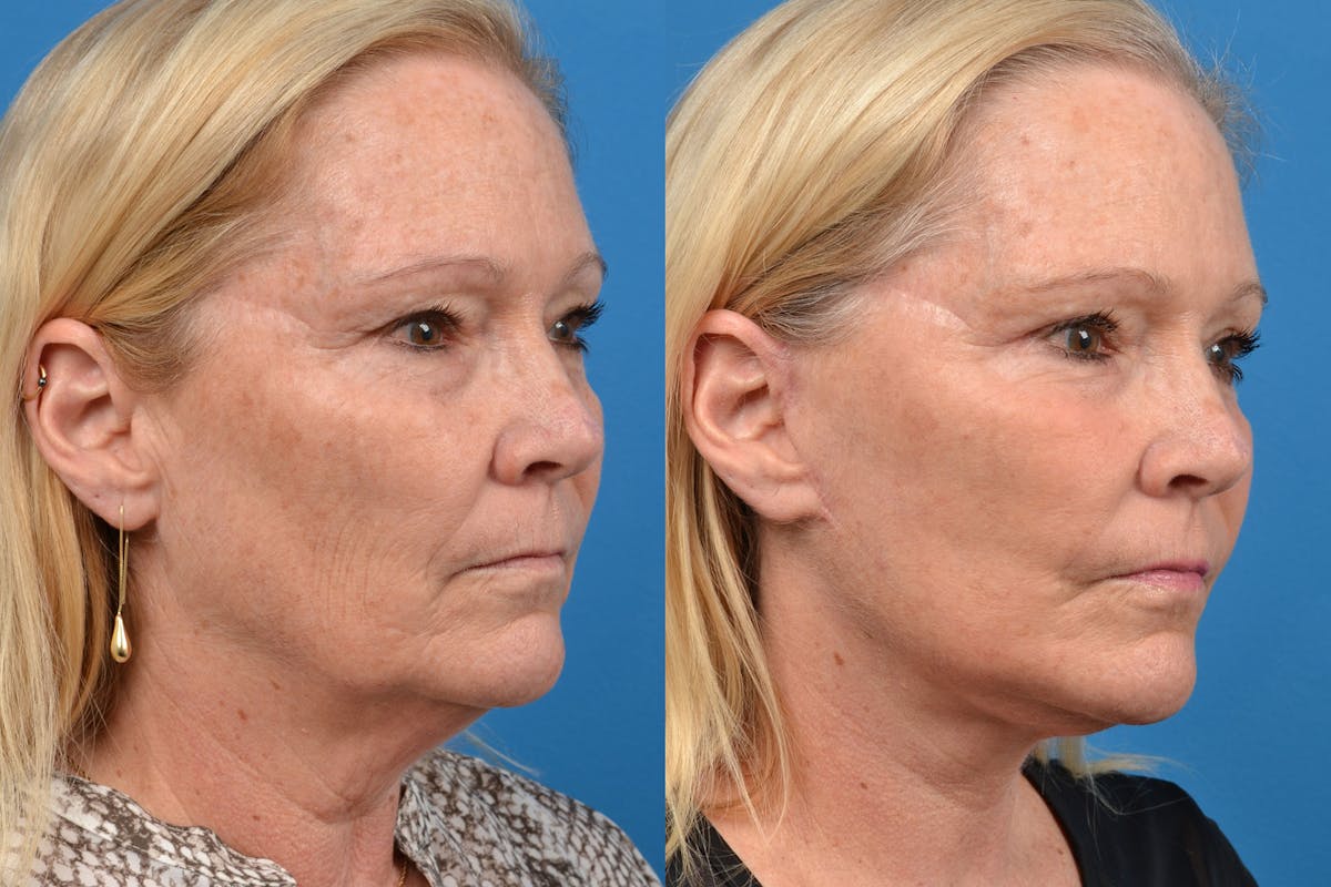 Facelift Before & After Gallery - Patient 122406100 - Image 2