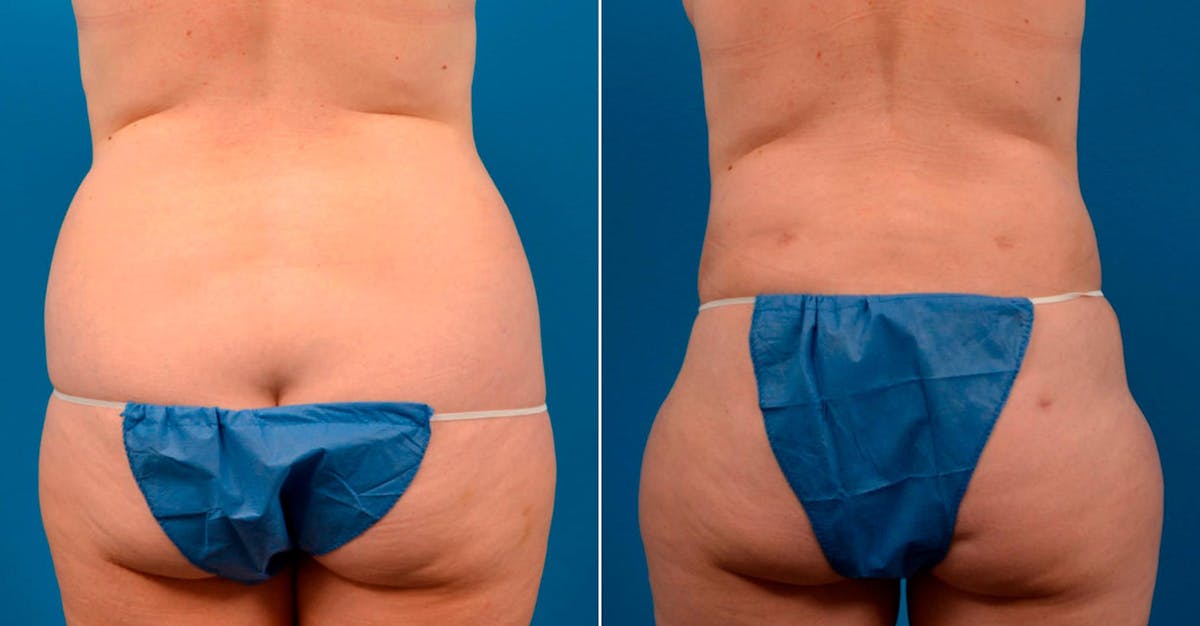 Liposuction Before & After Gallery - Patient 354085 - Image 1