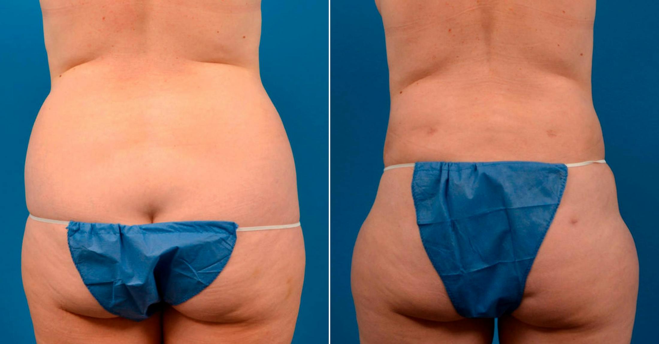Liponique Body Contouring Before & After Gallery - Patient 122406095 - Image 1