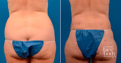 Hidden Liposuction  Before & After Gallery - Patient 316337 - Image 1