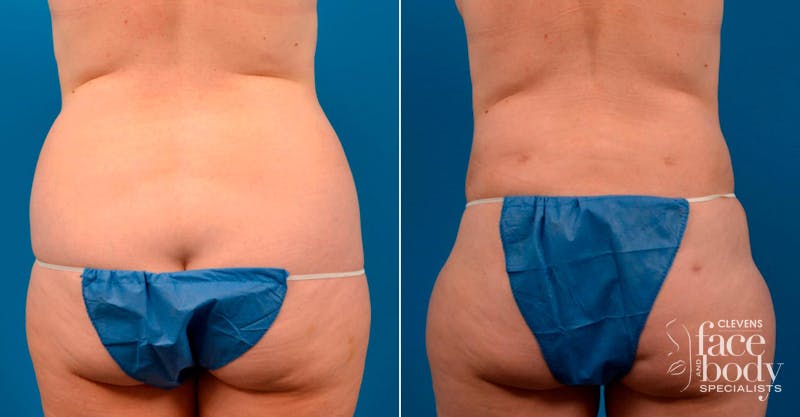Hidden Liponique Body Contouring Before & After Gallery - Patient 122406095 - Image 1