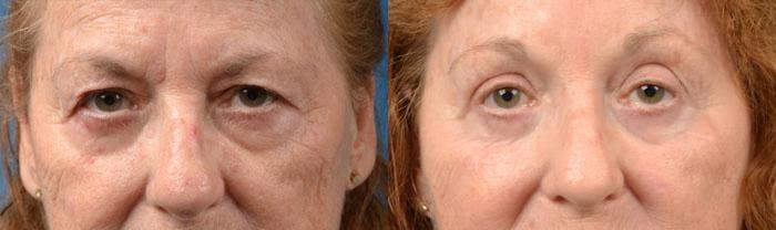 Eyelid Surgery Before & After Gallery - Patient 192874 - Image 1