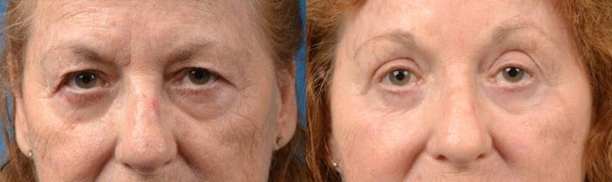 Eyelid Surgery Before & After Gallery - Patient 122406096 - Image 1