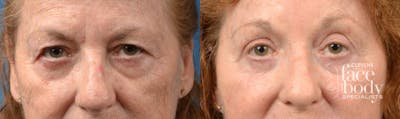 Eyelid Surgery Before & After Gallery - Patient 192874 - Image 1