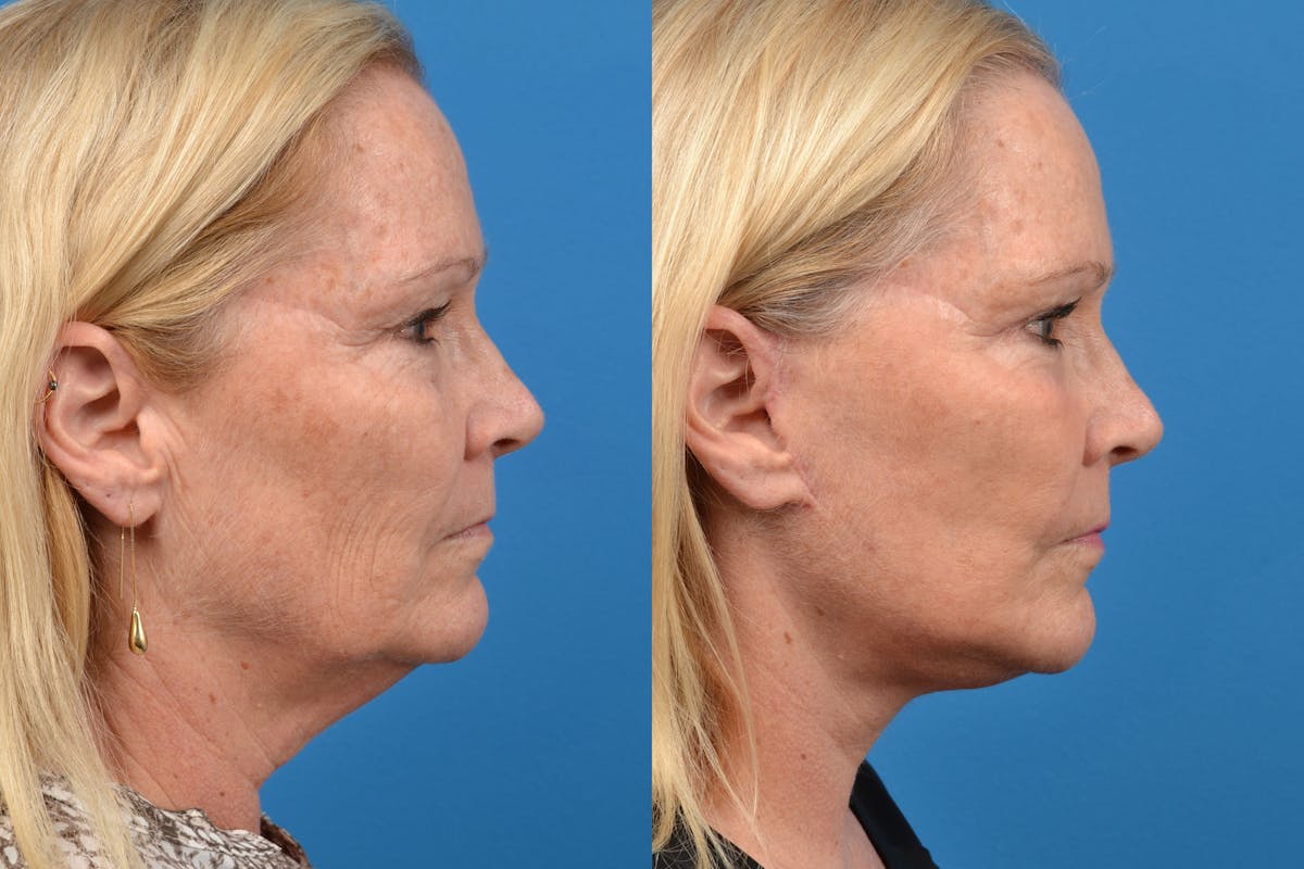 Facelift Before & After Gallery - Patient 122406100 - Image 3
