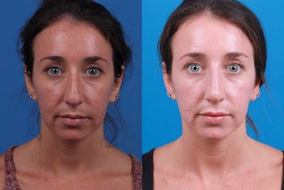 Lip Fillers Before & After Gallery - Patient 122406098 - Image 1