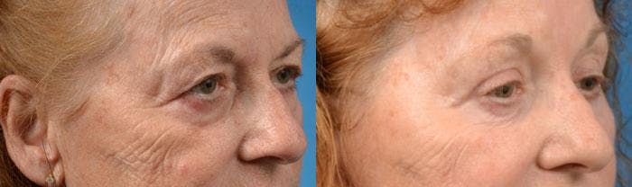 Eyelid Surgery Before & After Gallery - Patient 122406096 - Image 2