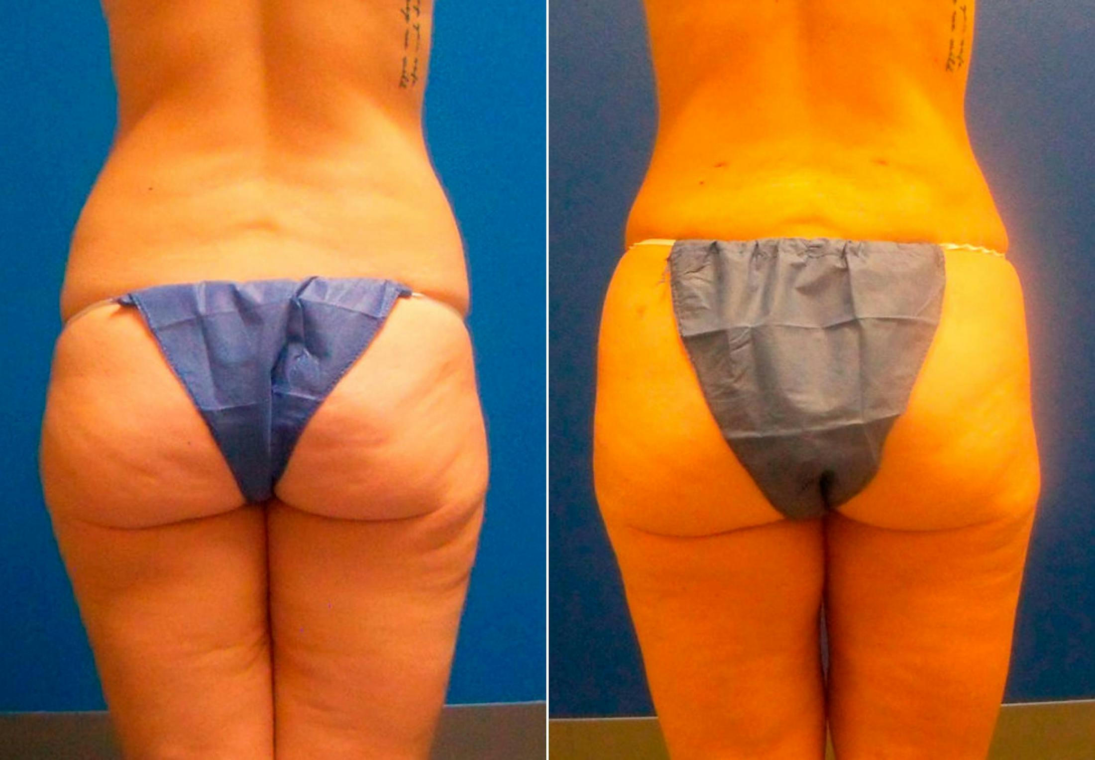 Liponique Body Contouring Before & After Gallery - Patient 122406097 - Image 1