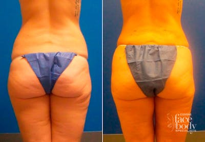 Hidden Liposuction  Before & After Gallery - Patient 327112 - Image 1