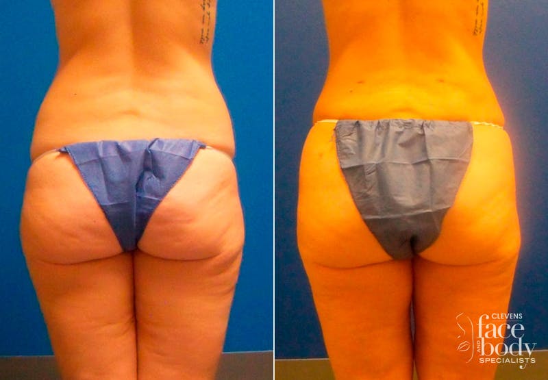 Hidden Liposuction Before & After Gallery - Patient 327112 - Image 1