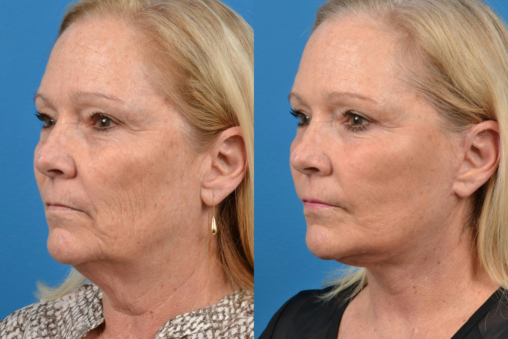 Facelift Before & After Gallery - Patient 122406100 - Image 4