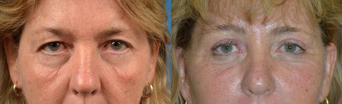 Eyelid Surgery Before & After Gallery - Patient 596062 - Image 1