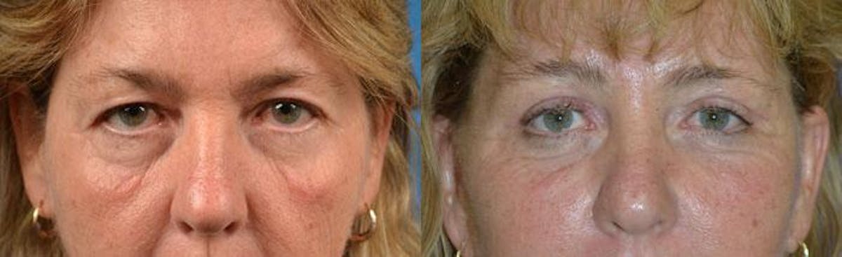 Eyelid Surgery Before & After Gallery - Patient 122406099 - Image 1