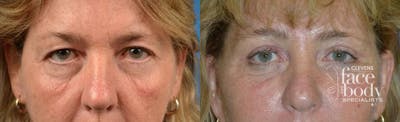 Eyelid Surgery Before & After Gallery - Patient 596062 - Image 1