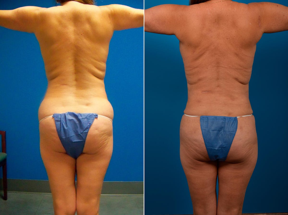 Liposuction Before & After Gallery - Patient 323921 - Image 1