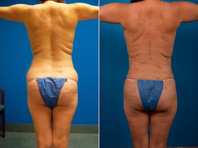 Liposuction Before & After Gallery - Patient 323921 - Image 1