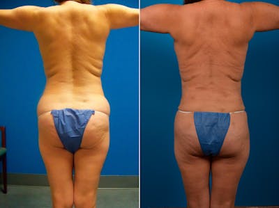 Hidden Liposuction  Before & After Gallery - Patient 401602 - Image 1