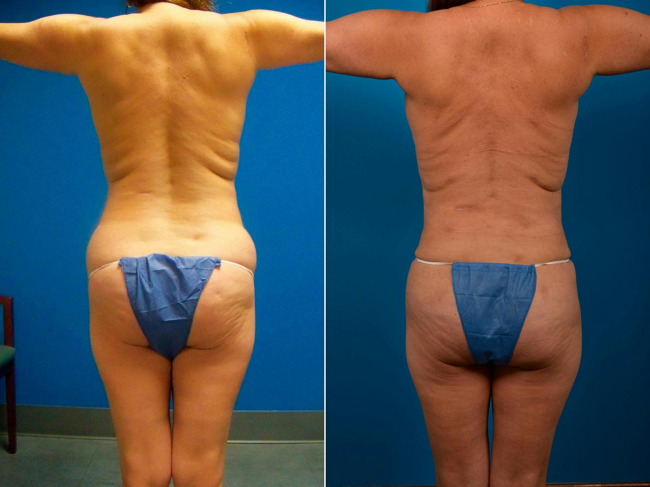 Liponique Body Contouring Before & After Gallery - Patient 122406101 - Image 1