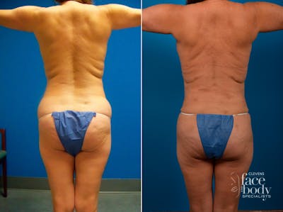Hidden Liposuction  Before & After Gallery - Patient 401602 - Image 1