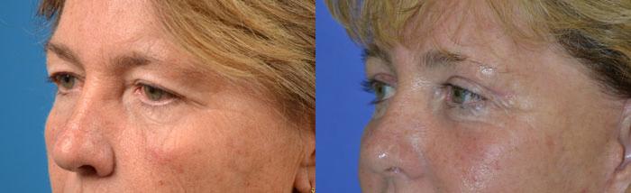 Eyelid Surgery Before & After Gallery - Patient 596062 - Image 2
