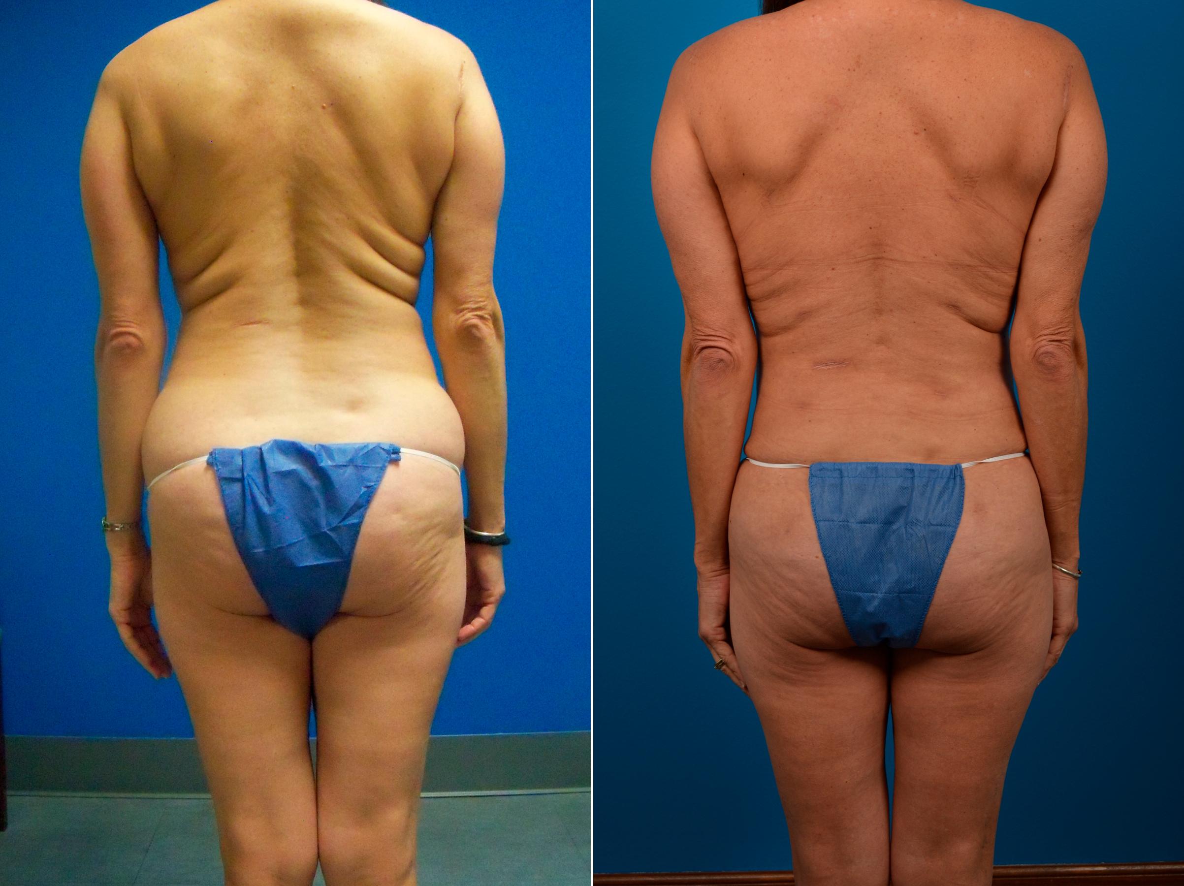 Hidden Liposuction  Before & After Gallery - Patient 401602 - Image 2