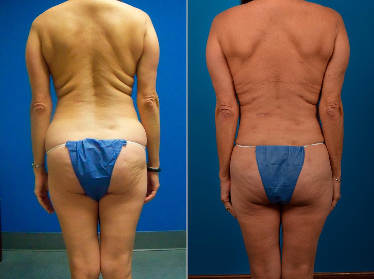 Liposuction Before & After Gallery - Patient 323921 - Image 2
