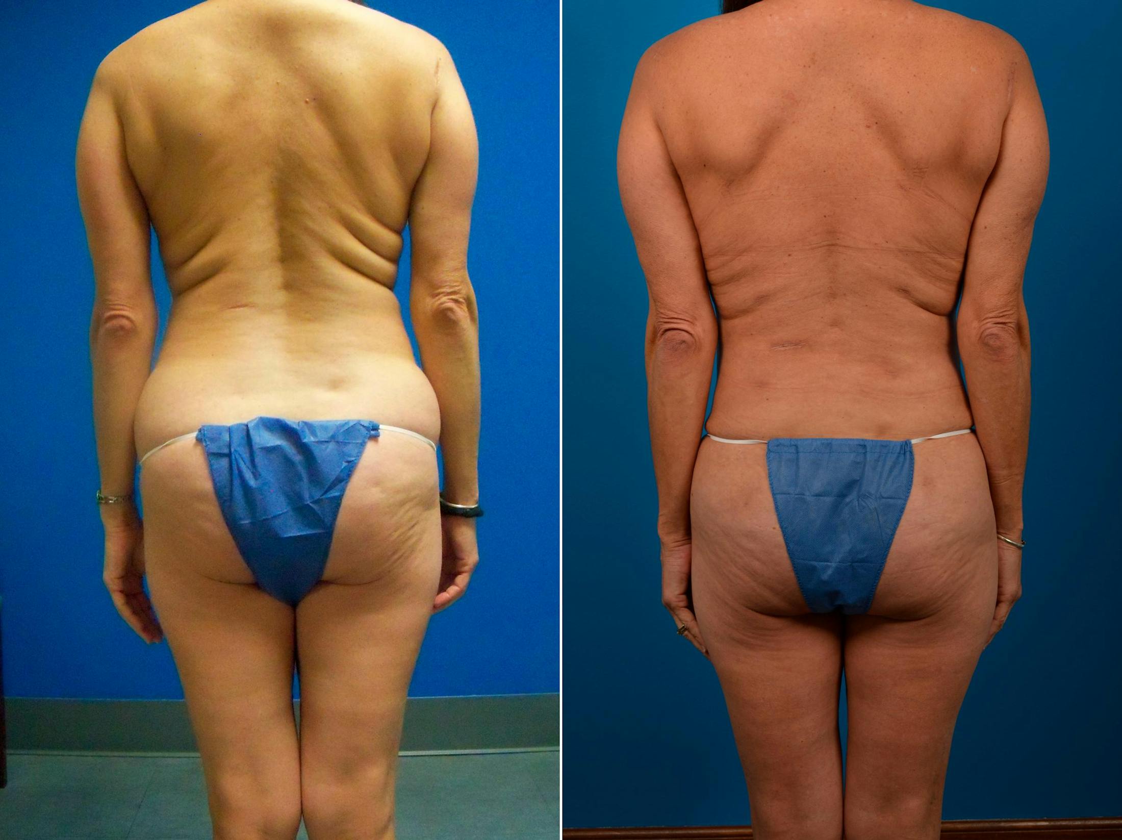 Liponique Body Contouring Before & After Gallery - Patient 122406101 - Image 2