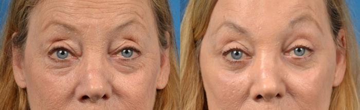 Eyelid Surgery Before & After Gallery - Patient 906855 - Image 1