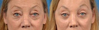 Eyelid Surgery Before & After Gallery - Patient 122406102 - Image 1