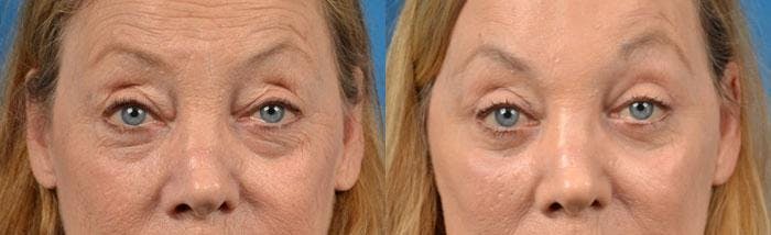 Eyelid Surgery Before & After Gallery - Patient 122406102 - Image 1