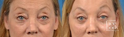 Eyelid Surgery Before & After Gallery - Patient 906855 - Image 1