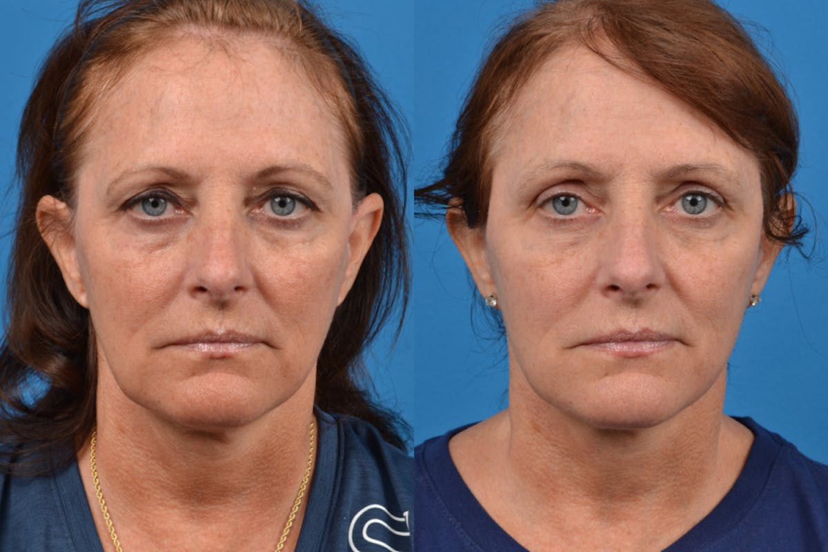 Facelift Before & After Gallery - Patient 122406107 - Image 1