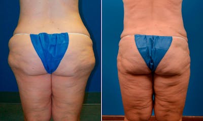 Liposuction Before & After Gallery - Patient 205879 - Image 1