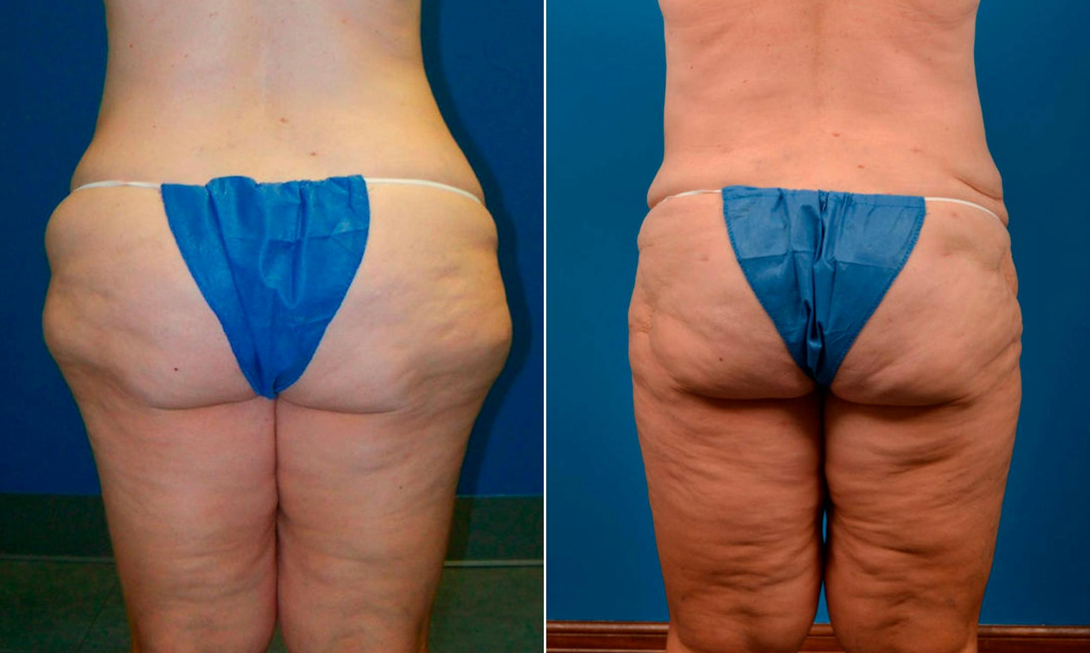 Liponique Body Contouring Before & After Gallery - Patient 122406103 - Image 1