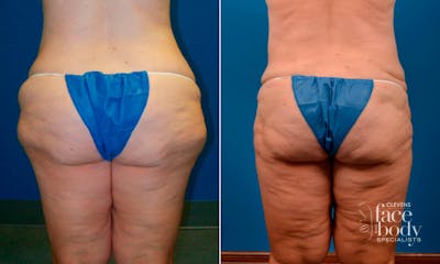 Hidden Liposuction  Before & After Gallery - Patient 398958 - Image 1