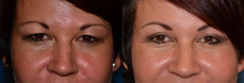 Eyelid Surgery Before & After Gallery - Patient 342441 - Image 1