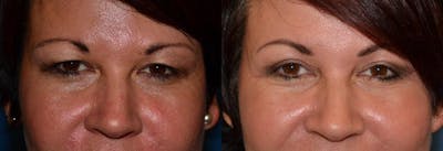 Eyelid Surgery Before & After Gallery - Patient 122406104 - Image 1